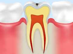初期むし歯【CO】