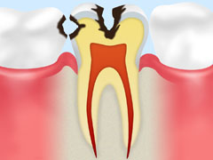 象牙質のむし歯【C2】