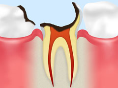 歯根に達したむし歯【C4】