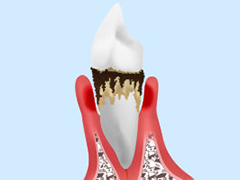 段階4：重度歯周炎
